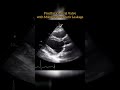 Prosthetic Mitral Valve #echocardiogram #echo   Echocardiography For Beginners