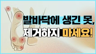 발바닥에 생긴 못, 제거하지 마세요!