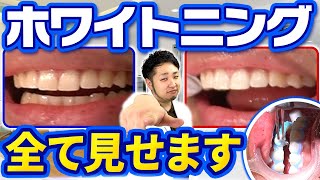 【プロの技】歯医者さんのホワイトニング治療工程全て公開！ #ホワイトニング #歯医者 #ホワイトニング治療