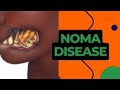 Understanding Noma: Its Causes, Symptoms, and Treatment - A Comprehensive Health Education Guide