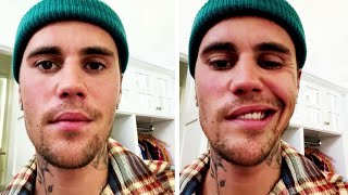 Justin Bieber Says Half His Face Is Paralyzed