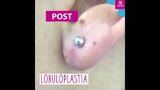 Dra Alexandra Mora - Lobuloplastia