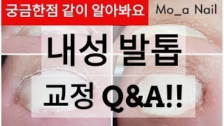 [Q\u0026A] 내성 발톱 교정의 모든것을 알아보자!!! 왜 파고들지? 무좀균?