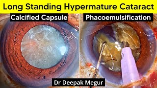 Rock Hard Hypermature Cataract, Tough Nut to Crack- Difficult Phacoemulsification- Dr Deepak Megur