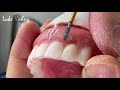 full process one hour special emergency denture with high esthetics