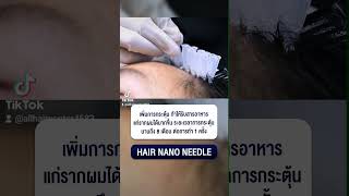 เทคนิคใหม่ ไม่ต้องปลูก กระตุ้นผมเกิดใหม่ 8 เดือน  HAIR NANO NEEDLE l By ALL HAIR CENTER