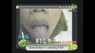 Dr. Slim 03-08-56 B2ฝังเข็ม*รักษาสิว