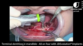 Terminal dentition in mandible  full-arch on four with JD Implants HD