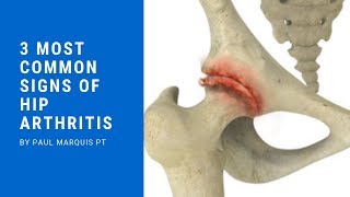 3 Most Common Signs of Hip Arthritis