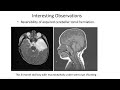 UT Southwestern Neurosurgery Faculty Lecture Series: Dale Swift, M.D.