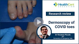 Dermoscopy of covid toes | Dr Vincenzo Piccolo