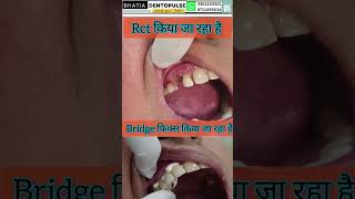 बिना दांतो की जड़ निकाले नए दांत लगाए-Bridging done on root canal treated tooth #shorts #teethbridge