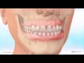 carriere® motion™ appliance for class iii correction patient education animation