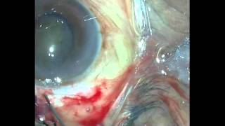 Small Incision Cataract Surgery (SICS) in difficult situations