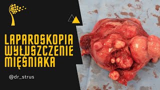 Laparoskopia - wyłuszczenie mięśniaka macicy // Laparoscopic myomectomy - enucleation of the myoma