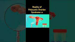 PCOS Demystified ;)#pcos #pcosinfertility#sustainablehealth