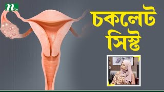 চকলেট সিস্ট বা এন্ডোমেট্রিওসিস কী? Health Show | স্বাস্থ্য প্রতিদিন |