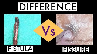 FISSURE Vs FISTULA - Difference