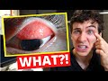 Contact Lenses Did THIS?! - What is GIANT Papillary Conjunctivitis (GPC)