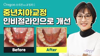 중년치아교정│인비절라인 투명교정으로 개선한 사례! 【오리건치과】에서 확인하세요!