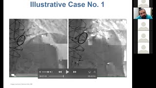 Why Torque Matters: Integrating Torqueable Microcatheters Into Your Practice