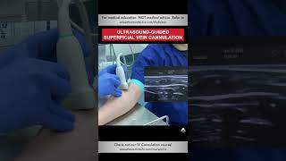 Ultrasound-guided Superficial Vein Cannulation | #shorts #ivcannulation #anesthesiology #nurse