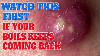 hidradenitis suppurativa | home remedies for boils | are boils contagious | Recurrent boils