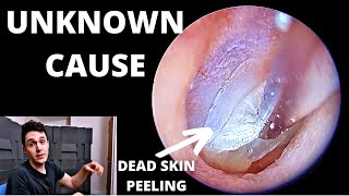 Mystery Dead Skin Formation Peeled Off Ear Drum (VIK VEER ANSWERED)