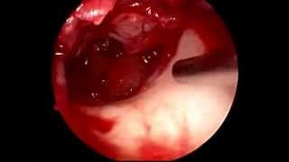 Endoscopic tympanoplasty showing middle ear glue