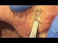 a minefield of blackheads dr. derm