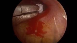 Grommet insertion for glue ear in right ear endoscopic
