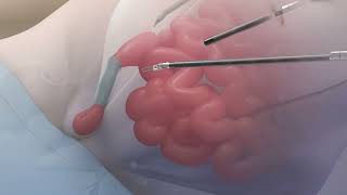 Inguinal Hernia Repair with Da Vinci | Dallas Mind & Body