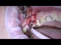 Anthogyr Axiom implant placement after sinus surgery and socket preservation