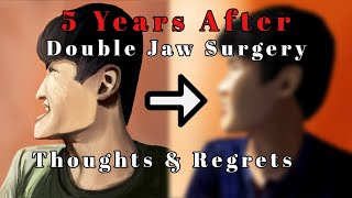 『Double Jaw Surgery In Singapore』『5 Years After - Thoughts \u0026 Regrets』