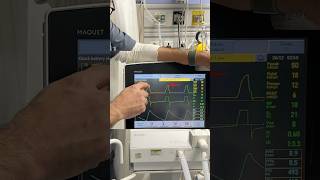 Ventilator graphics, blocked ET tube #criticalcare #medico #doctor #emergencymedicine #FOAM