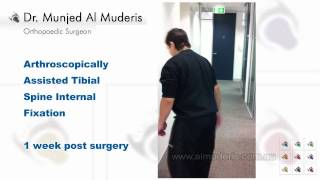 Arthroscopically Assisted Tibial Spine Internal Fixation - 1 week post surgery