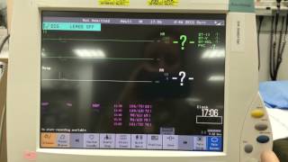 Pressure Cable Setup