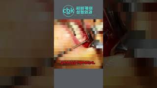 [닥터봉TV_CBK성형외과_최봉균]내 입안에 뭔가가 뚫고 나왔다...#shorts[ドクターボンTV_CBK整形外科_チェ·ボンギュン] 僕の口の中に何かが突き出てきた···#shorts