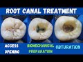Root Canal Treatment 🔵 Mandibular First Permanent Molar 🟡 access opening ⚪️ BMP 🟣 obturation 🔴