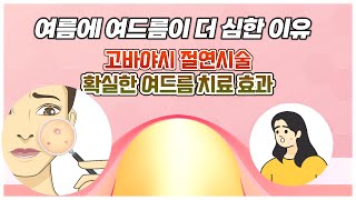 여드름 여름에 더 심한 이유와 확실한 치료 고바야시절연시술