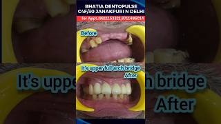 MAGICAL Upper Teeth Makeover in 3 days with Dental Bridge ; Dr. Praveen Bhatia #smilemakeover #teeth