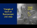 triangle of koch and importance in catheter ablation of svt