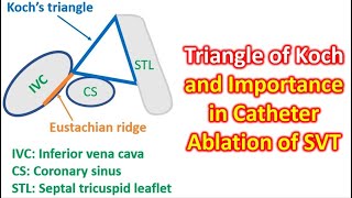 Triangle of Koch and Importance in Catheter Ablation of SVT