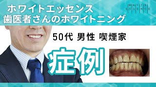 【ホワイトエッセンス】オフィスホワイトニング症例 50代男性・喫煙家　Tooth whitening