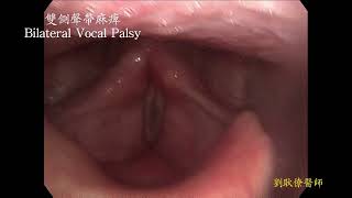 雙側聲帶麻痺 聲音沙啞 阻礙呼吸 bilateral vocal palsy hoarseness dyspnea