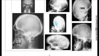 شرح أشعة العظام Bone X-Rays د. محمود سويلم