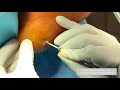 draining pus from a nail puncture wound through a foot