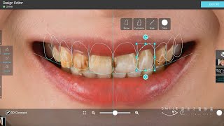 全瓷貼片療程再升級，笑容精準進化！蒔美DSD數位微笑設計