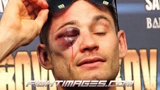 Boxer Chris Algieri's GROTESQUE Eye after the Ruslan Provodnikov fight; AND HE WON!