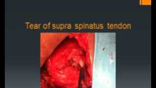 Rotator cuff repair Chennai | Dr.A.K.Venkatachalam, opioid sparing surgeon